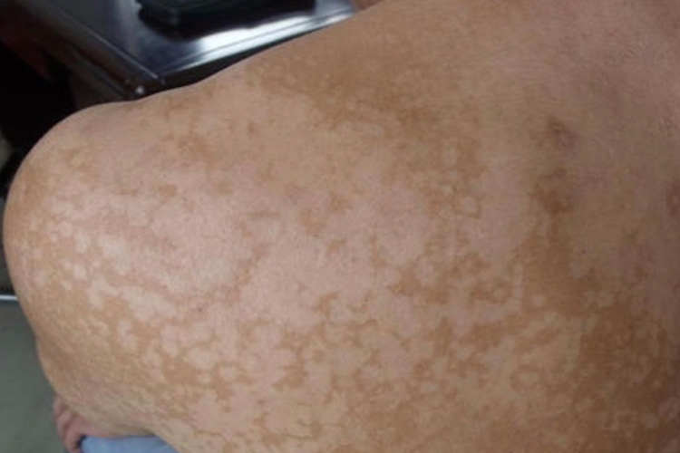 肩背汗斑症状图