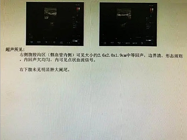 观察到患儿阴茎发育正常,在右侧阴囊部位未触及睾丸,右侧腹股沟外环口