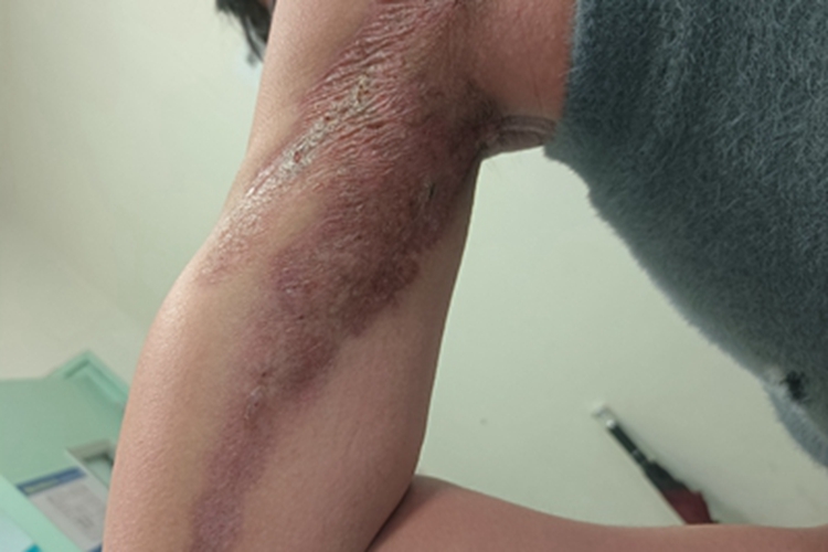 硬化萎缩性苔藓瘢痕图