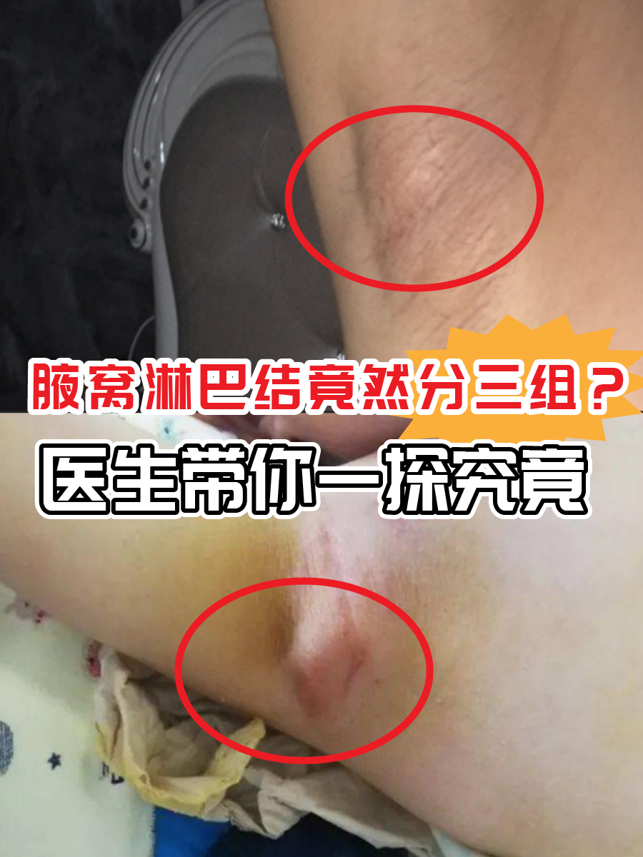 腋窝淋巴结竟然分三组？医生带你一探究竟