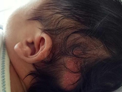 新生儿皮脂腺增生头皮有一块发红图.jpg