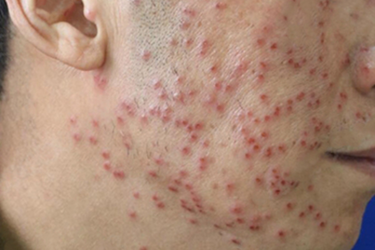 疱疹样湿疹面部小水疱图 疱疹样湿疹面部小水疱图