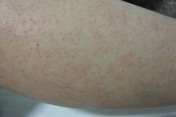 急性接触性皮炎小腿红点图