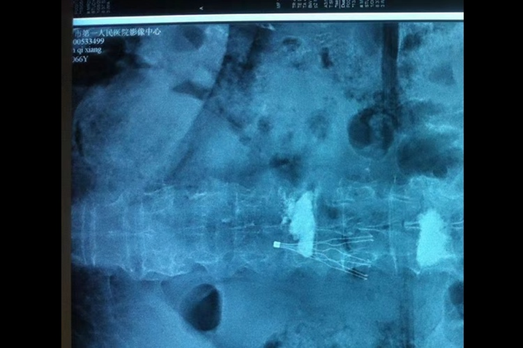 骨质疏松的X线图 骨质疏松的X线图