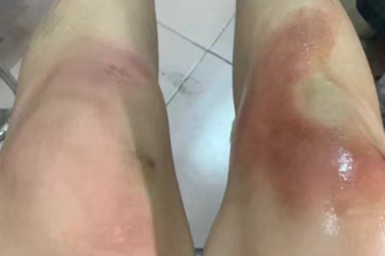 烫伤膝盖红斑图