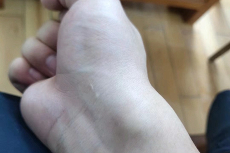 腱鞘囊肿手腕鼓大包图 腱鞘囊肿手腕鼓大包图