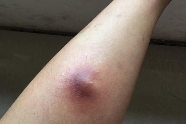 皮脂腺囊肿手臂凸起的脓包图 皮脂腺囊肿手臂凸起的脓包图