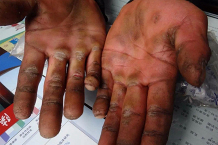 掌跖角化病手掌皲裂图 掌跖角化病手掌皲裂图