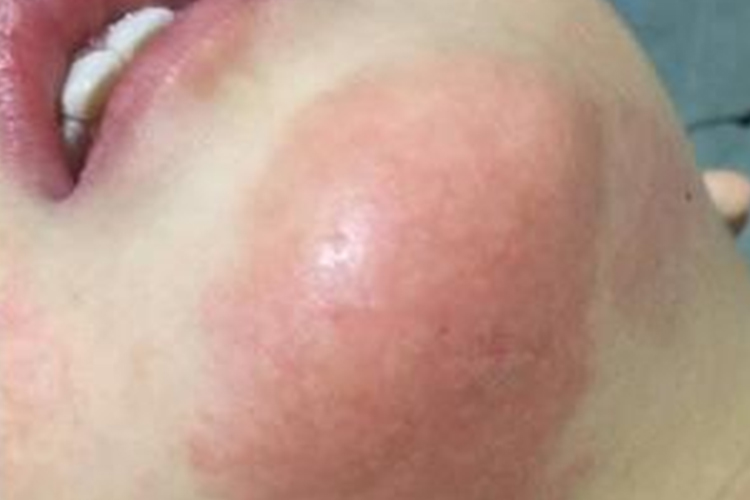 下巴体癣图 下巴体癣图