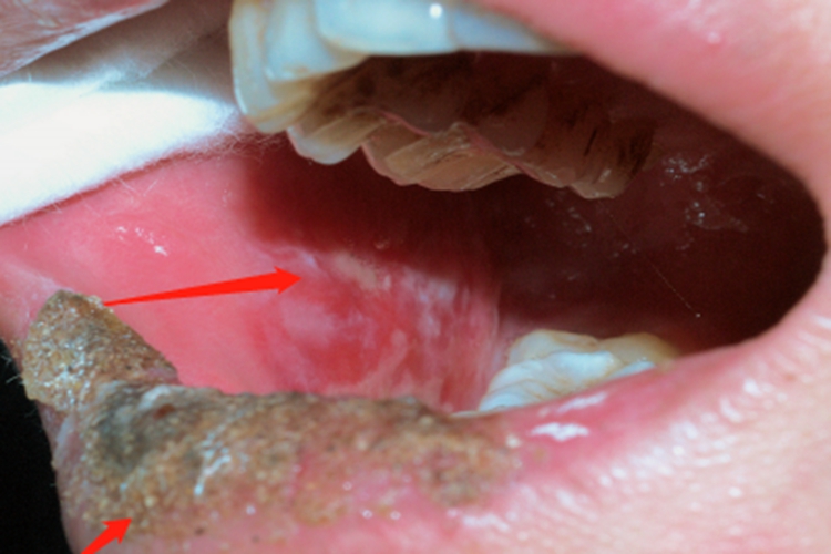 糜烂型口腔扁平苔藓口腔症状图