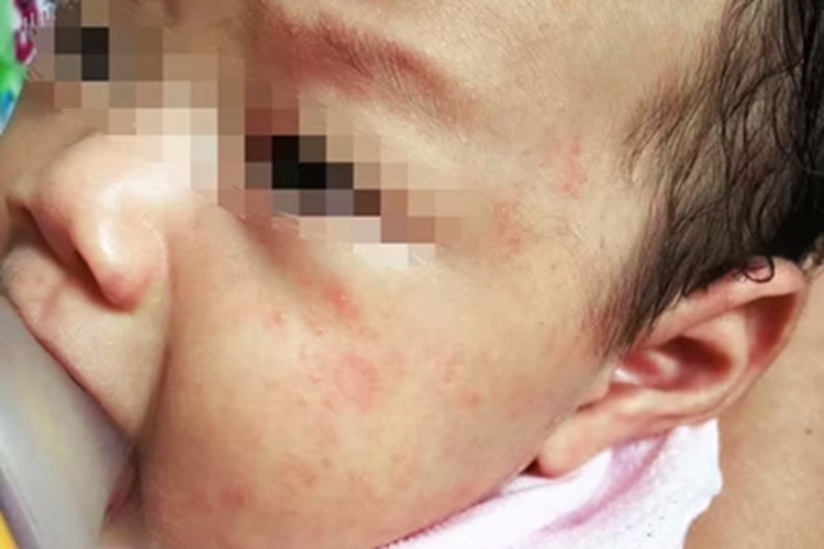 新生儿红斑面部有小疙瘩图