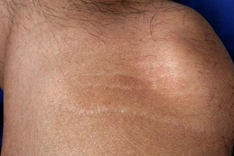 关节萎缩纹图 关节萎缩纹图