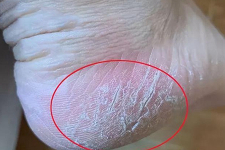 桥本甲状腺炎脚部症状图 桥本甲状腺炎脚部症状图