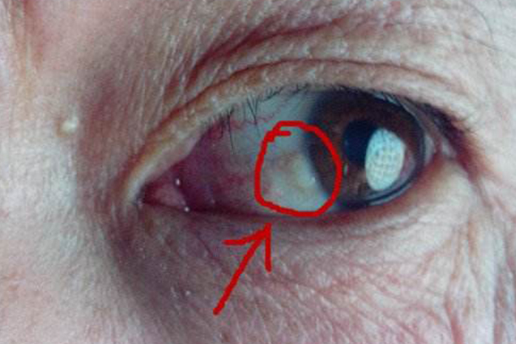 睑裂斑眼白增生图
