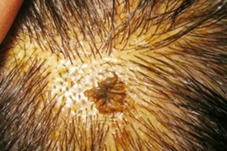寻常疣头皮症状图 寻常疣头皮症状图