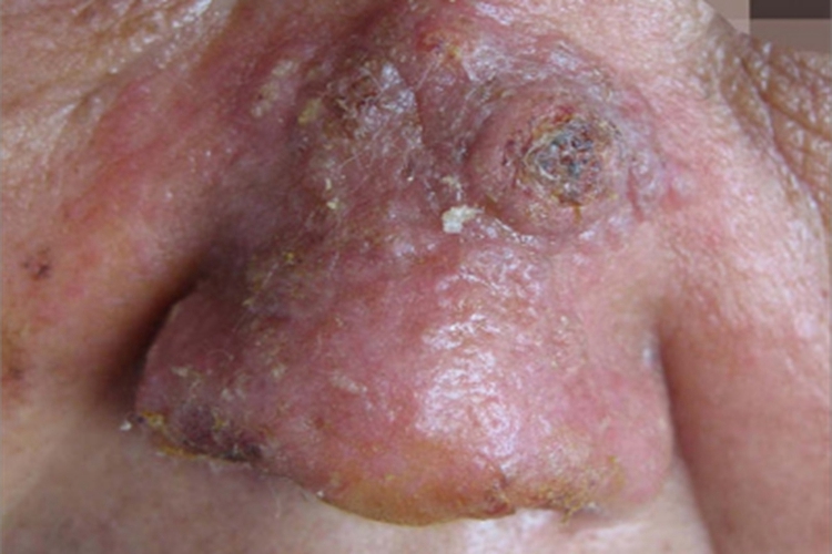 增殖性皮炎鼻部结痂图 增殖性皮炎鼻部结痂图