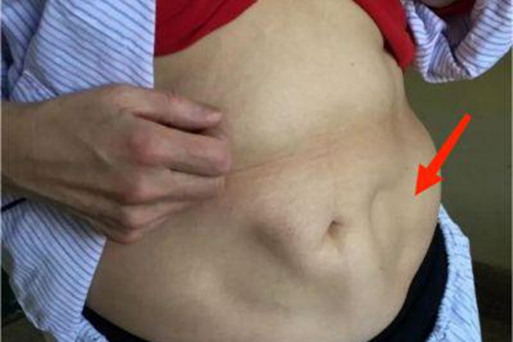 进行性脂肪营养不良有坑图