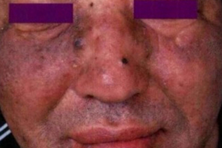 天疱疮面部红斑图 天疱疮面部红斑图