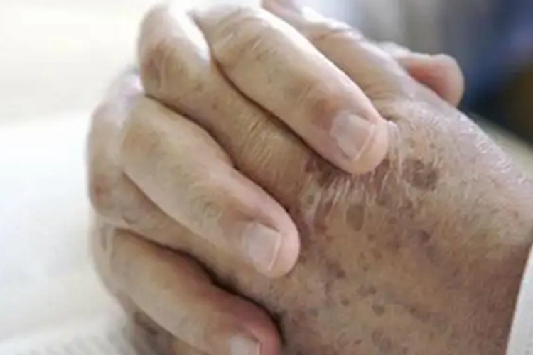 光线性角化病手背长斑图