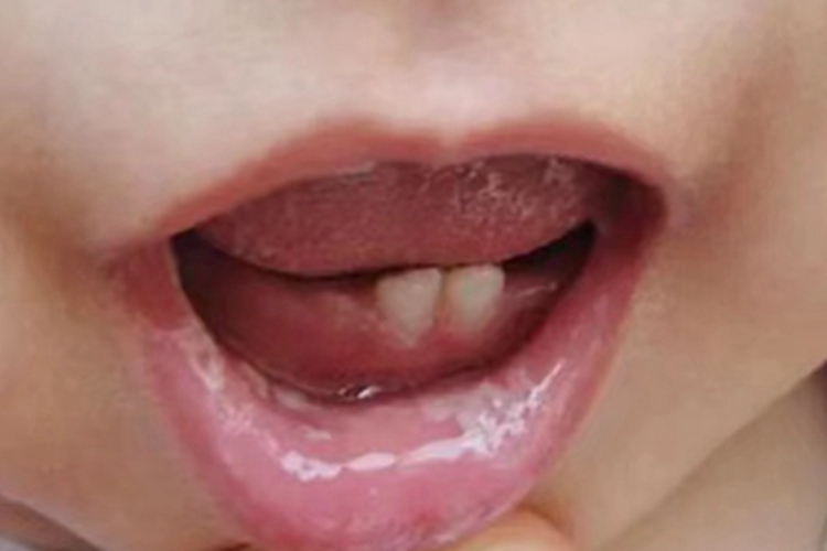 鹅口疮嘴唇白斑图 鹅口疮嘴唇白斑图