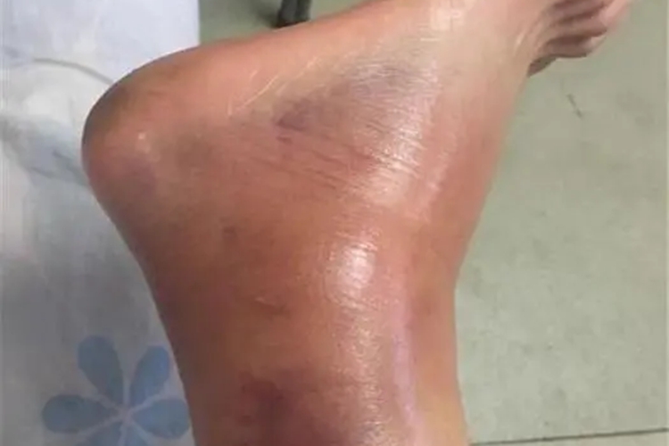 脚踝肿胀瘀血图