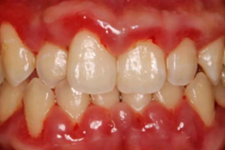 急性坏死性龈口炎牙龈肿图