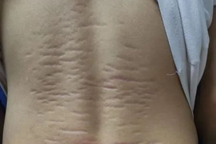 萎缩纹背部条纹图 萎缩纹背部条纹图