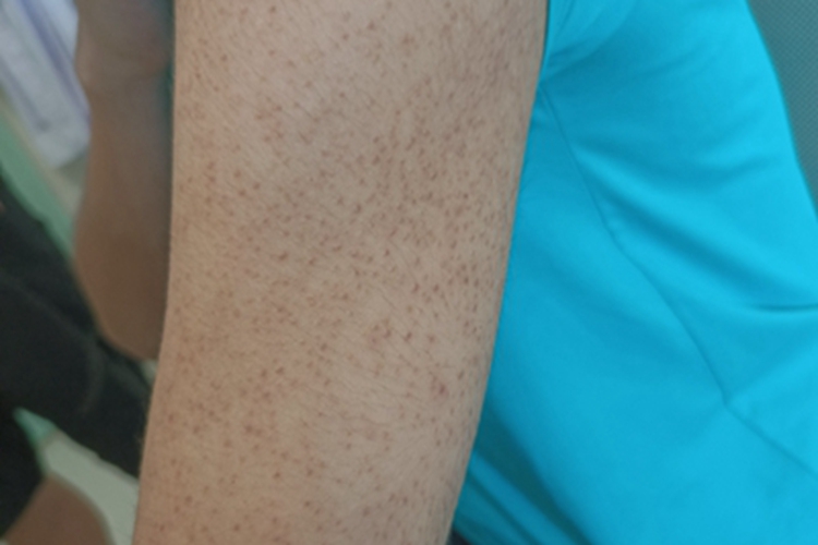 毛发苔藓胳膊上有密集小黑斑图