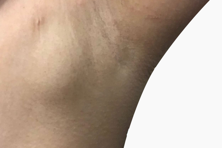 儿童腋下霍奇金淋巴瘤图 儿童腋下霍奇金淋巴瘤图