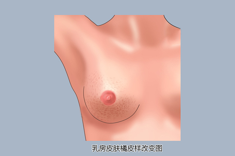 乳房皮肤橘皮样改变图