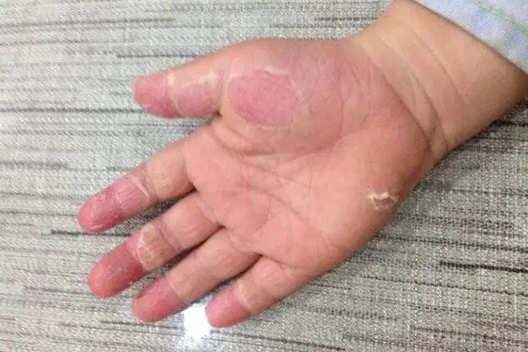 小孩鳞屑角化型手癣图
