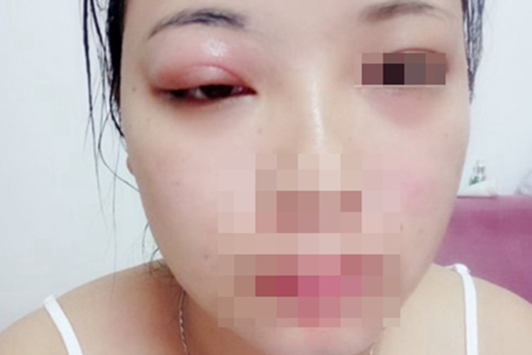 海鲜过敏眼睑红肿图