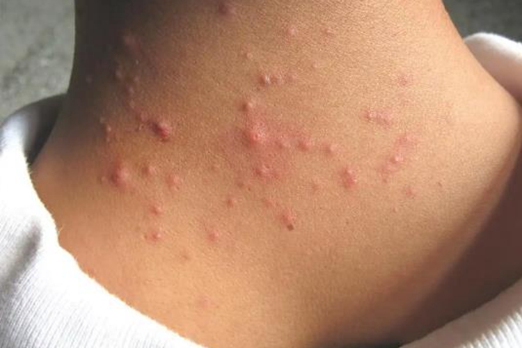 颈部毛囊炎丘疹图 颈部毛囊炎丘疹图