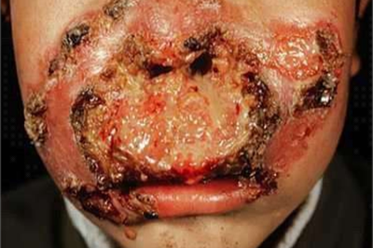 瘰疬性皮肤结核面部溃疡图