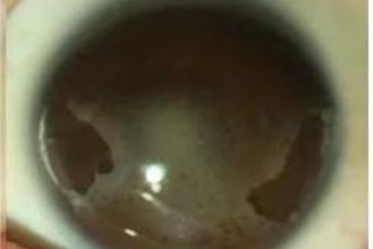 带状角膜病变眼球大片白斑图 带状角膜病变眼球大片白斑图