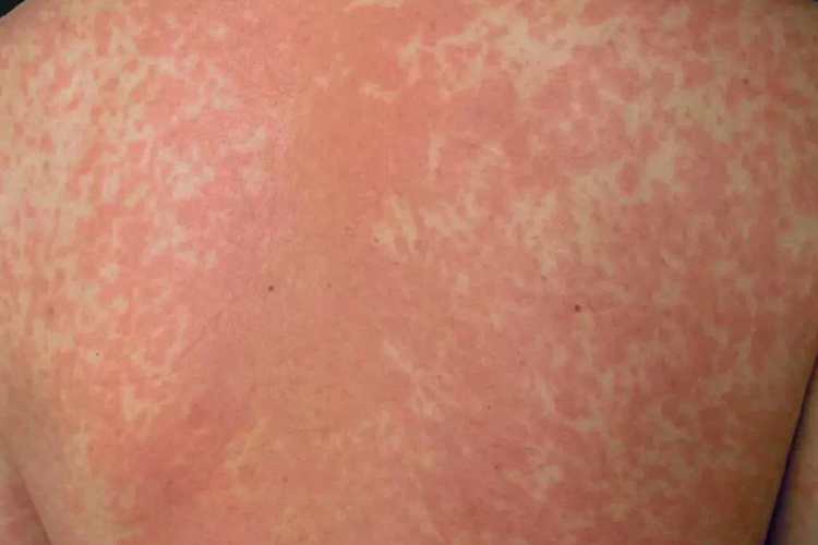 服用碘-131后皮肤过敏图