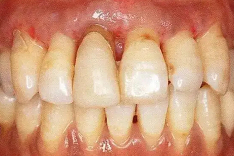 牙周炎早期深牙周袋图