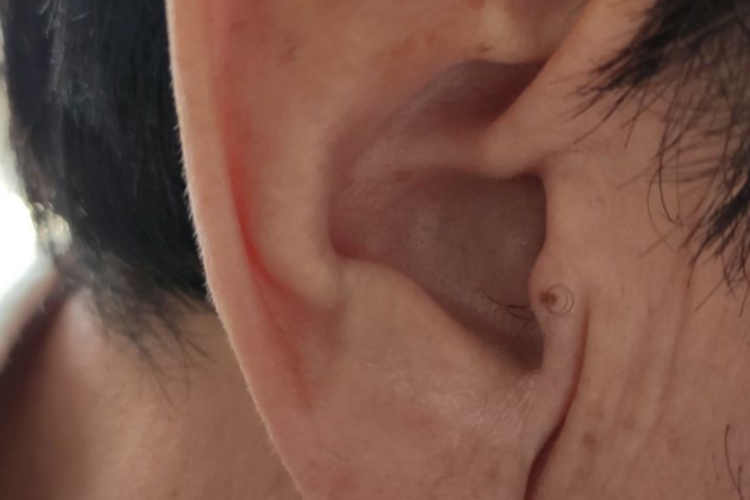 耳廓软骨膜炎早期图片 