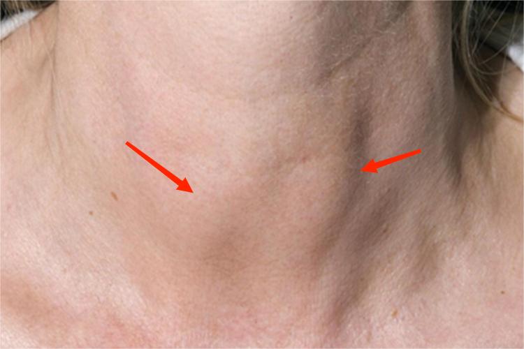 桥本甲状腺炎前颈肿块图