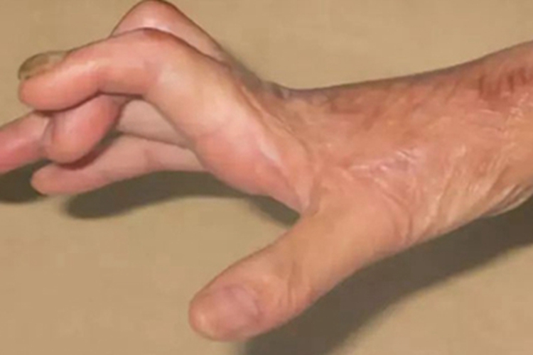 缺血性肌挛缩手部症状图 缺血性肌挛缩手部症状图