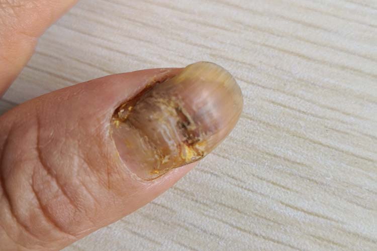 近端甲下型甲癣图