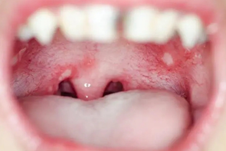 二期口腔梅毒咽后壁白斑图