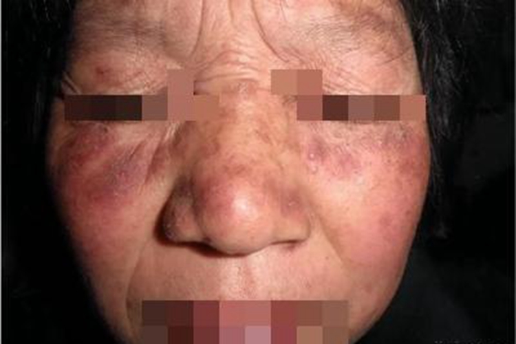 假性卟啉病面部症状图