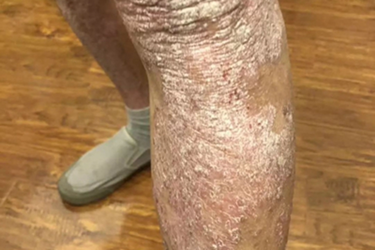 松皮癣小腿脱屑