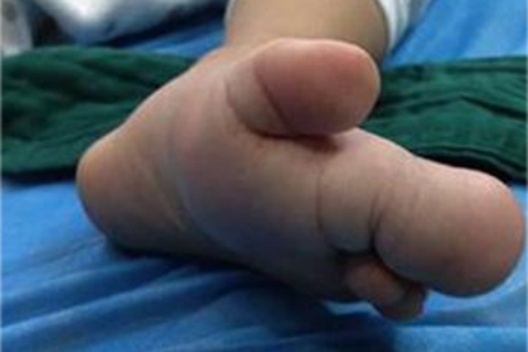 巨指畸形脚趾又粗又大图