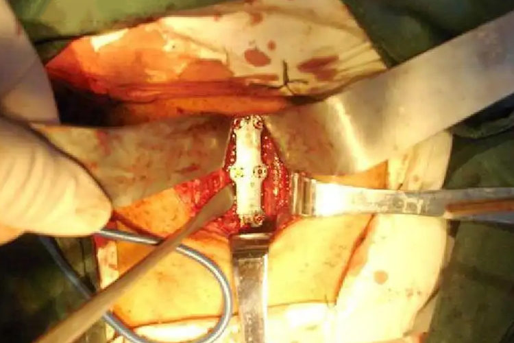 颈椎前路手术入路切开图