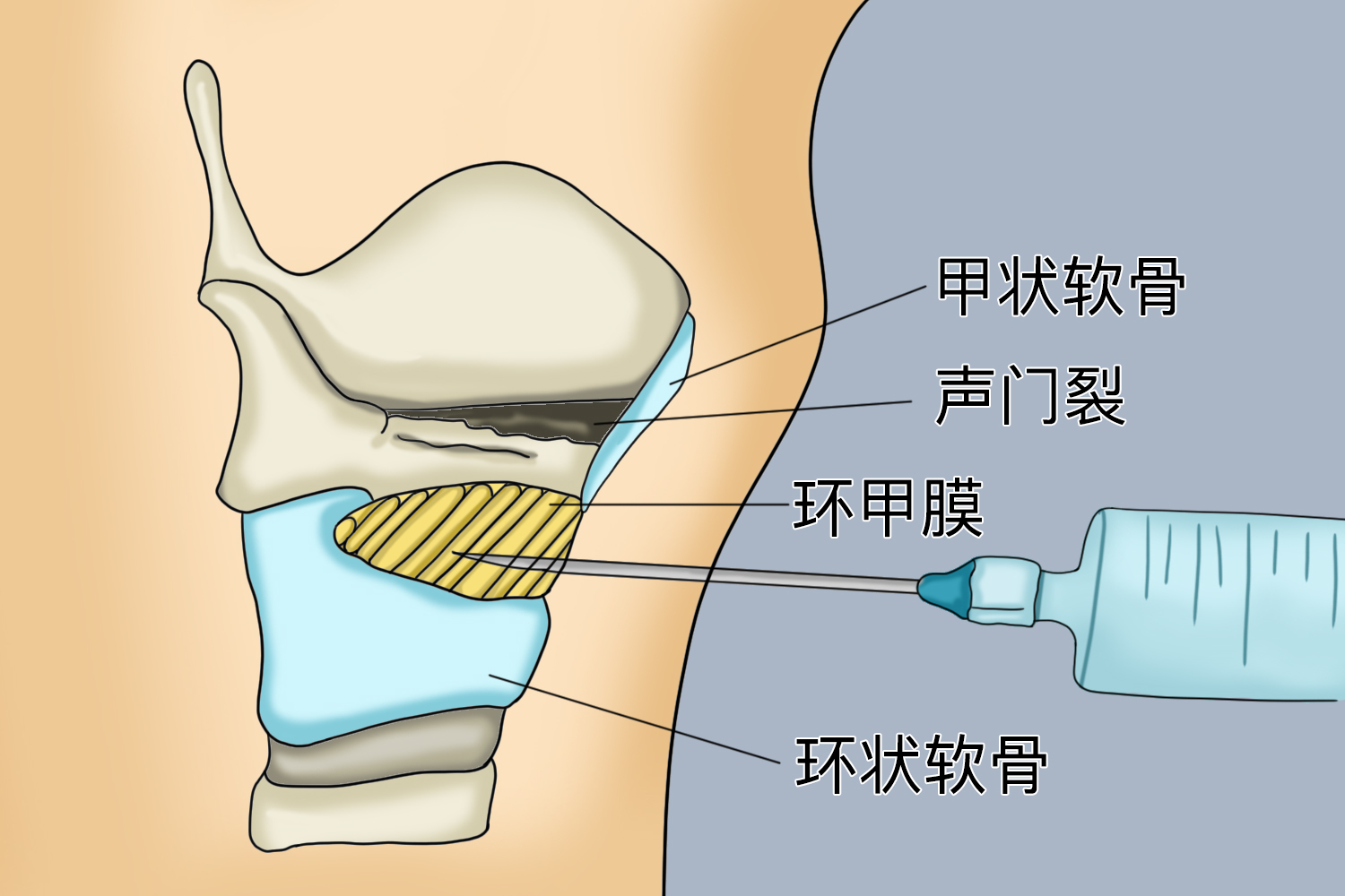 环甲膜穿刺的位置图 环甲膜穿刺的位置图