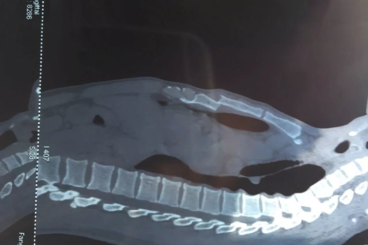 胸骨骨折剑突凸起图