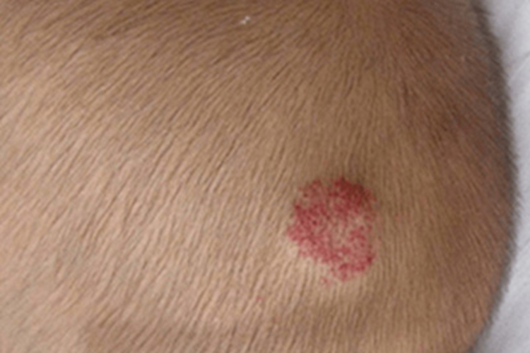 混合型婴儿血管瘤头皮症状图