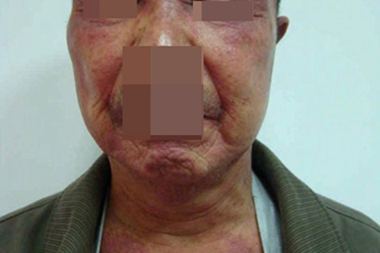 血管萎缩性皮肤异色病颈部症状图 血管萎缩性皮肤异色病颈部症状图